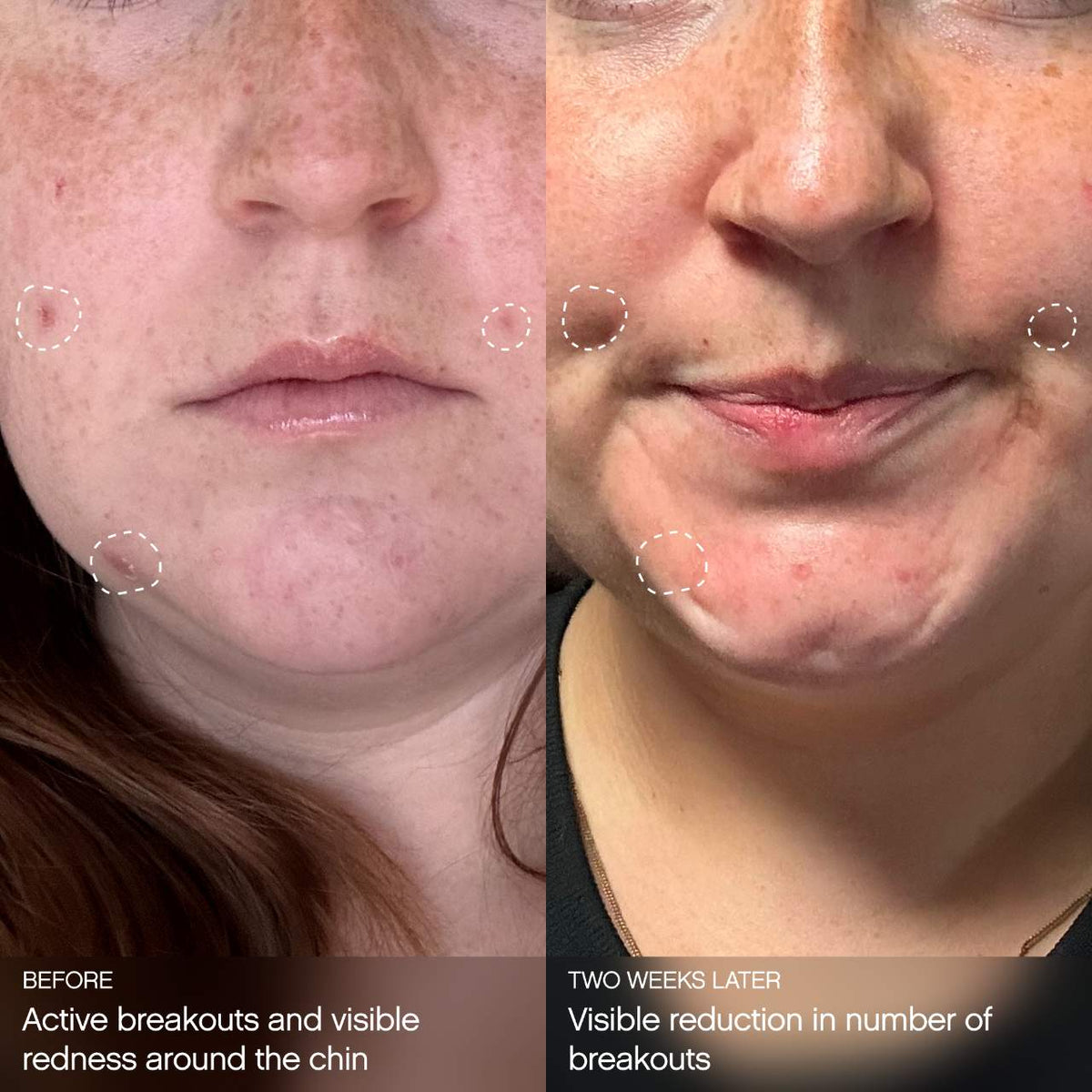 Topicals  Clearly Clarifying & Calming Mask For Breakout-Prone Skin