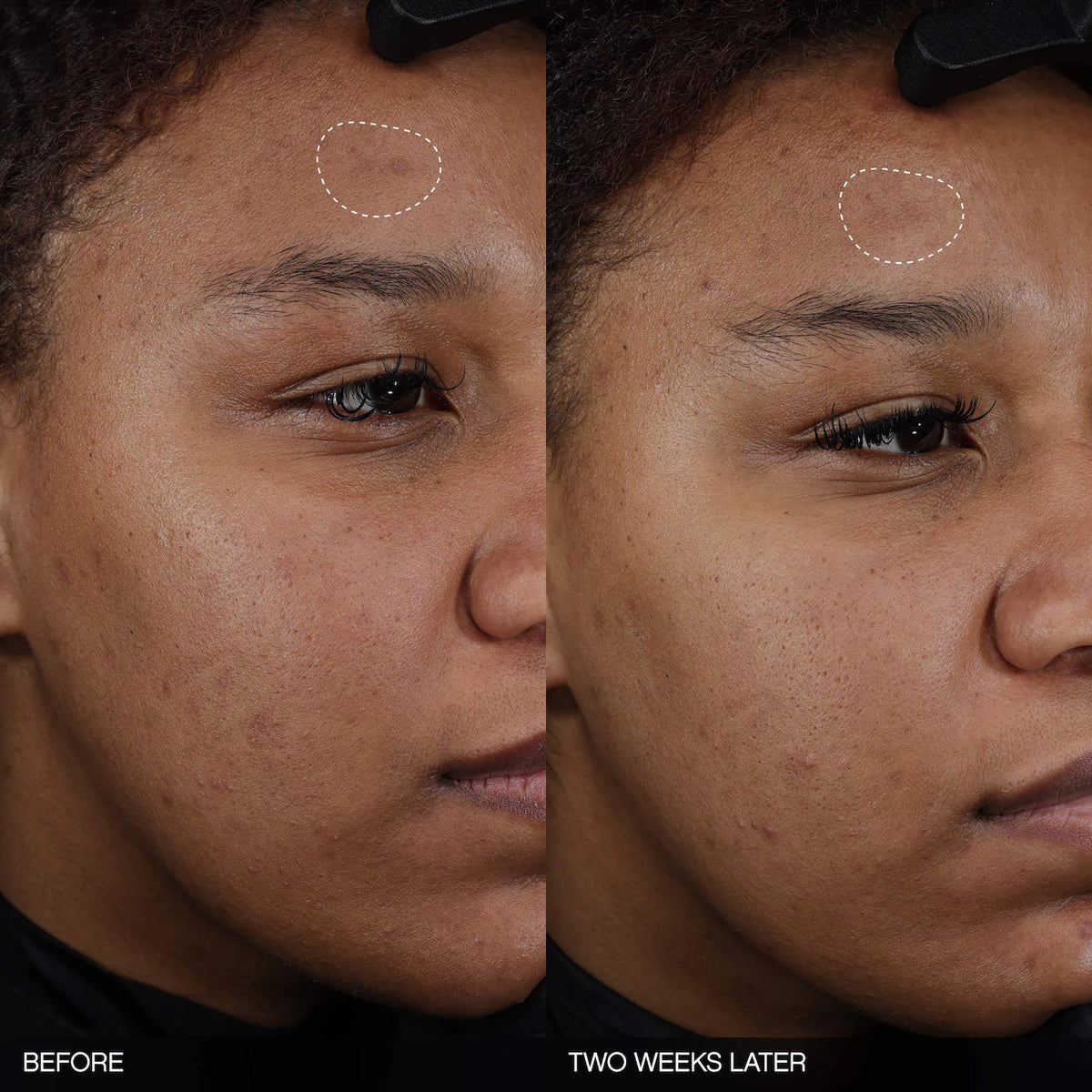 Topicals  Faded Tranexamic Acid Dark Spot Patches for Hyperpigmentation