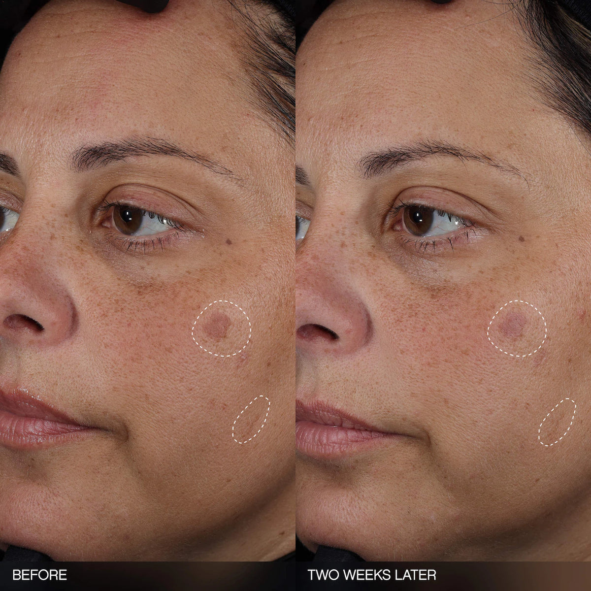 Topicals  Faded Tranexamic Acid Dark Spot Patches for Hyperpigmentation