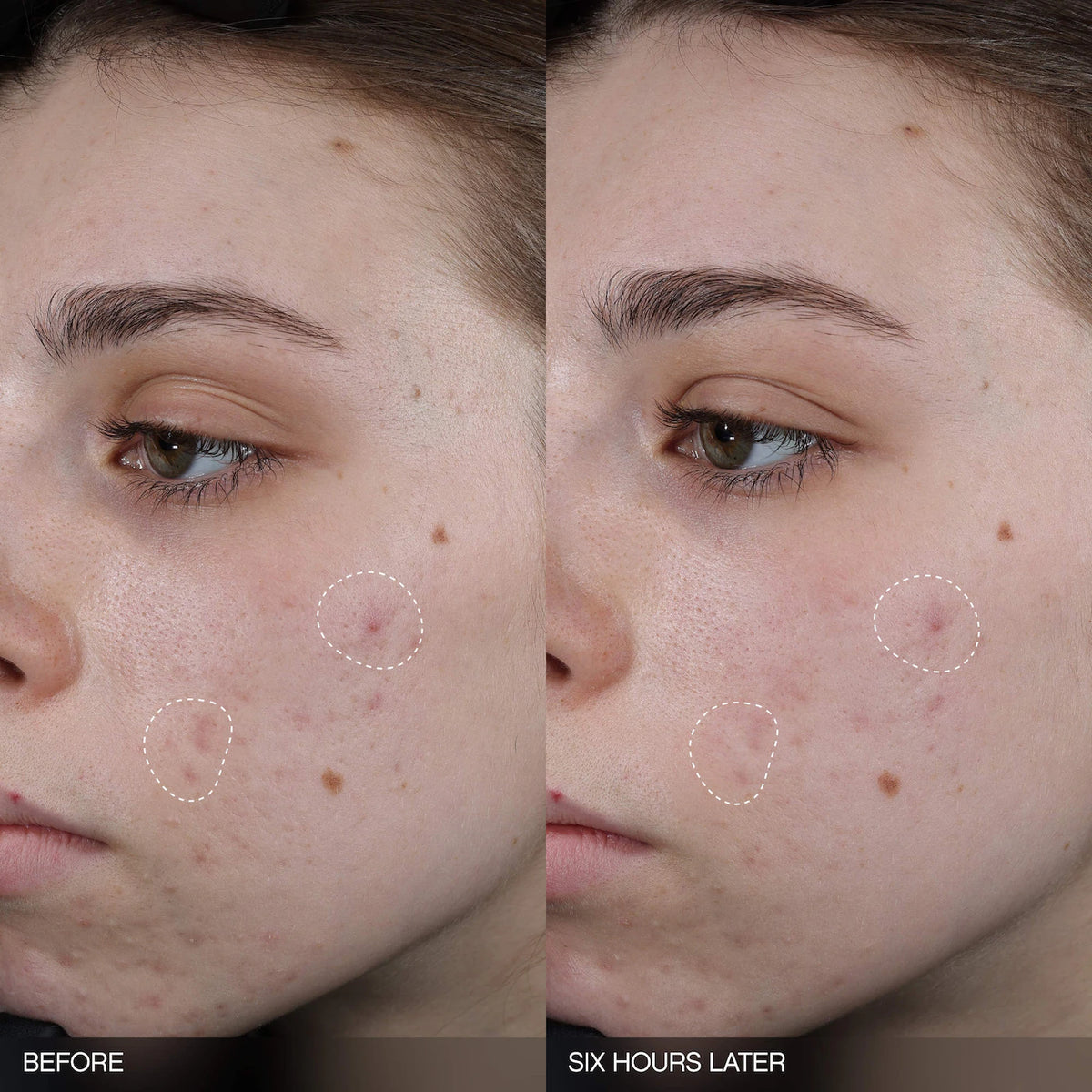 Topicals  Faded Tranexamic Acid Dark Spot Patches for Hyperpigmentation